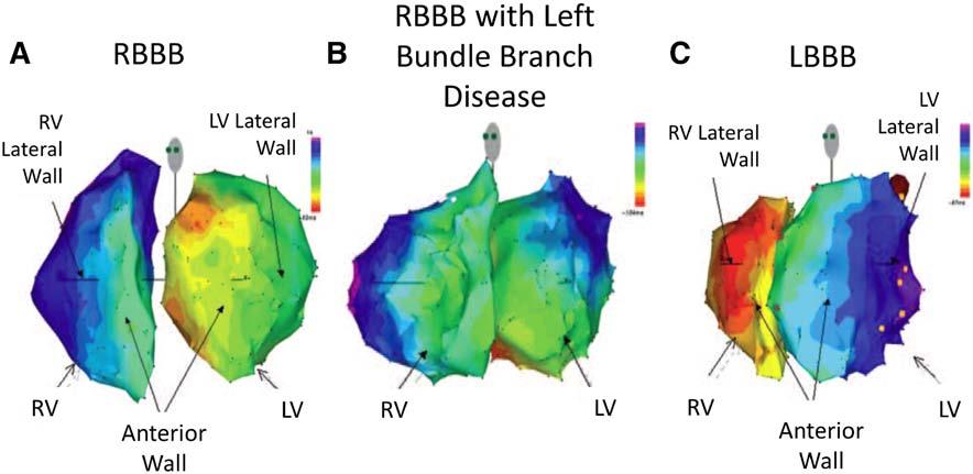 Bilchick LV Free Wall Pacing in RBBB 545 Figure 1. Electrical activation contact maps.
