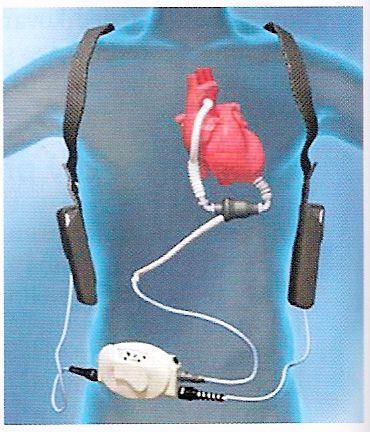 6.2 Mechanické srdeční podpory levé komory firmy HeartMate (Netuka IKEM, Novinky v kardiologii 2015) Obr. 24. Pumpa HeartMate II Obr.25.