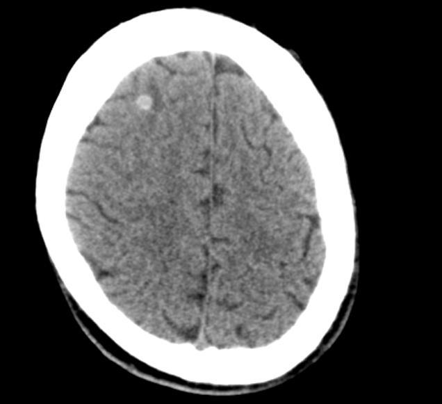 Komplikace v souvislosti se zavedením nitrolebního čidla byly zaznamenány celkem ve 4 případech (7,14 %); žádná z nich si však nevyžádala intervenci neurochirurga a neměla fatální dopad.