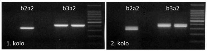 Obr. 2B - Výsledek vyšetření BCR-ABL pomocí nested RT-PCR. Vizualizace PCR produktů na 1,5% agarózovém gelu barveném ethidum bromidem. laboratorní technologie Obr.