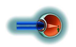 Myopie krátkozrakost Je nejčastěji způsobená prodloužením předozadní osy oka, vzácněji vyšší lomivostí optických prostředí zvýšeným zakřivením rohovky.