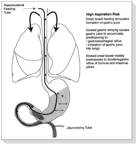 vědomí Am J Crit Care, 2008 Nov;17(6):512-9 Gastric residual volume