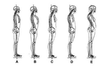 Hodnocení držení těla z bočního pohledu uvádí ve své publikaci Prevence vadného držení těla na základní škole také Kolisko a Fojtíková (2003).