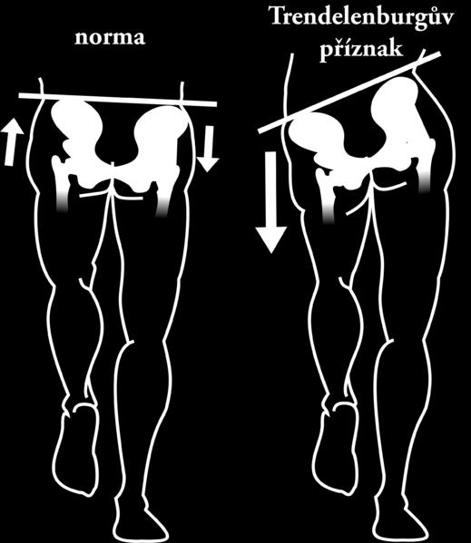 Obrázek 17: Postoj v normě a Trendelenburgův příznak 29 8.4. Rhombergův test Tento test provádíme opět ve stoje, požádáme dítě, aby zavřelo oči a pozorovatel si všímá, jak se u dítěte mění postoj.