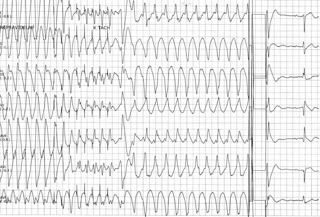 tachykardie defibrilací či kardioverzí je život zachraňujícím úkonem, a následná prognóza stavu pacienta záleží na rozsahu infarktu myokardu.