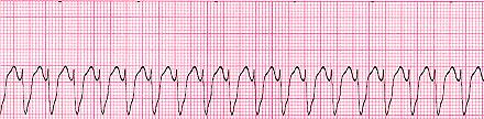 Síňová tachykardie Abnormální vlny P, mohou být i skryty v QRS Fkomor=140/220/min QRS jsou normální AV junkční tachykardie Současně aktivují komory i síně P bude skryta za komplexem QRS F=140-180/min