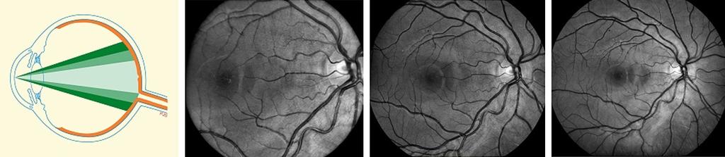 2. Snímání očního pozadí fundus kamerou 2.1.