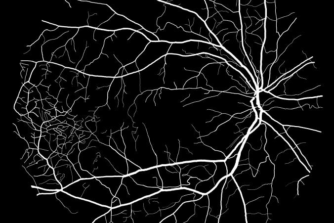7 vidíme výsledky snímku 06-ote_R_1 postiženého diabetickou retinopatií. Je patrné, že klasifikátor dosáhl na daném snímku poměrně dobré přesnosti, ikdyž byl trénován na zdravé části databáze.