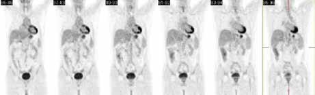 1) prokázalo časný relaps onemocnění několik drobných ložisek s metabolizmem vitálních nádorových buněk v retroperitoneu (obr. 2), v levém podklíčku (obr. 3) a v hrudní stěně vlevo (obr.