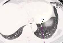 7. 2009. Následné přešetření pomocí PET/CT (obr. 5) potvrdilo negativní nález, taktéž nádorové markery byly v normálním rozmezí. Byla tedy konstatována kompletní remise onemocnění a od 30. 7.