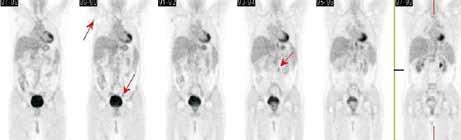 Obr. 8. PET + CT srpen 2010. penie grade 2), a to i přesto, že irinotekan byl podáván po celou dobu v plné dávce, tj. 350 mg/m 2 (tedy v celkové dávce 700 mg à 3 týdny).