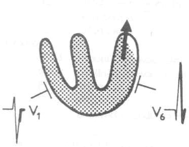 Interpretace tvaru komorového komplexu, úseku ST a polarity vlny T V komplexu QRS platí obecná zásada, že směřuje-li směr postupu vlny depolarizace směrem k registrační elektrodě (u unipolárního
