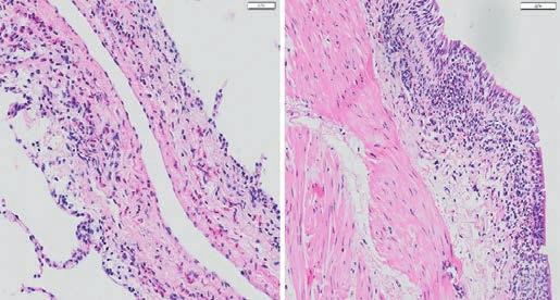 Bronchoskopie v celkové anestezii byla u nás provedena v dubnu 2018 zde endoskopicky normální nález, cytologicky z bronchoalveolární laváže (BAL) lymfocytární (36 %) a eozinofilní alveolitida (Eo 13