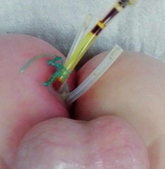 V celkové anestezii proběhla v antibiotické profylaxi incize, drenáž a transsfinkterická ligatura anorektální fistuly (obrázek 3), kultivačním vyšetřením stěru z perianální oblasti byla prokázána