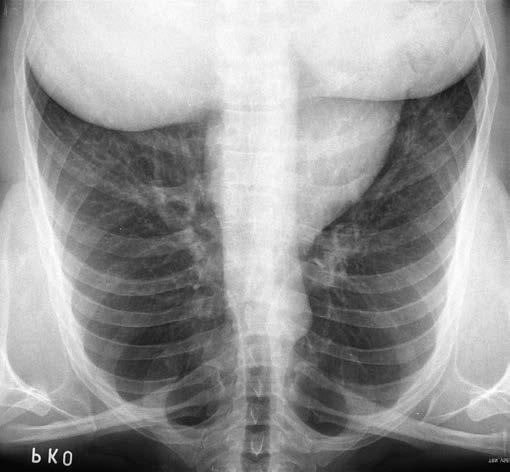 PARI-O-PEP a specifická dieta u CF. Ve spolupráci s osteologem byla zahájena terapie osteoporózy (Caltrate tbl 1-0-0, kalcitriol Rocaltrol 0,25 μg tbl 1-0-0, denosumab Prolia 60 mg inj.