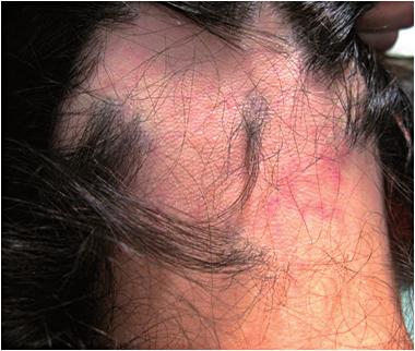 Akné nevhodná a vhodná léčba M. Hašková Obr. 1 Alopecia areata před léčbou Obr. 2 Obr. 3 Obr.