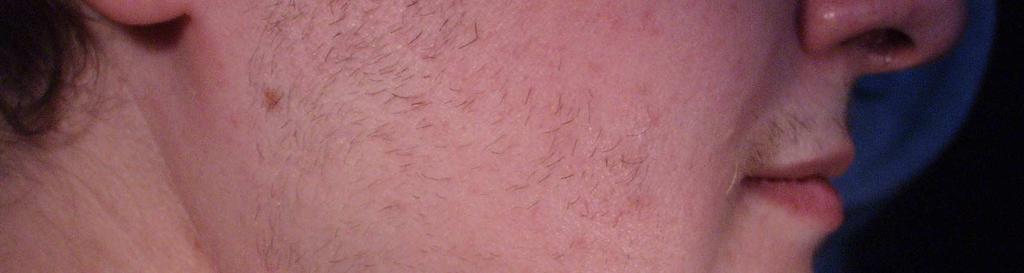 Estradiol bývá u PCOS v normě, může být zvýšen estron periferní konverzí androgenů na estrogeny v tukové tkáni, ten se ale stanovuje pouze vzácně. U PCOS bývá mírně zvýšen prolaktin (62, 181).