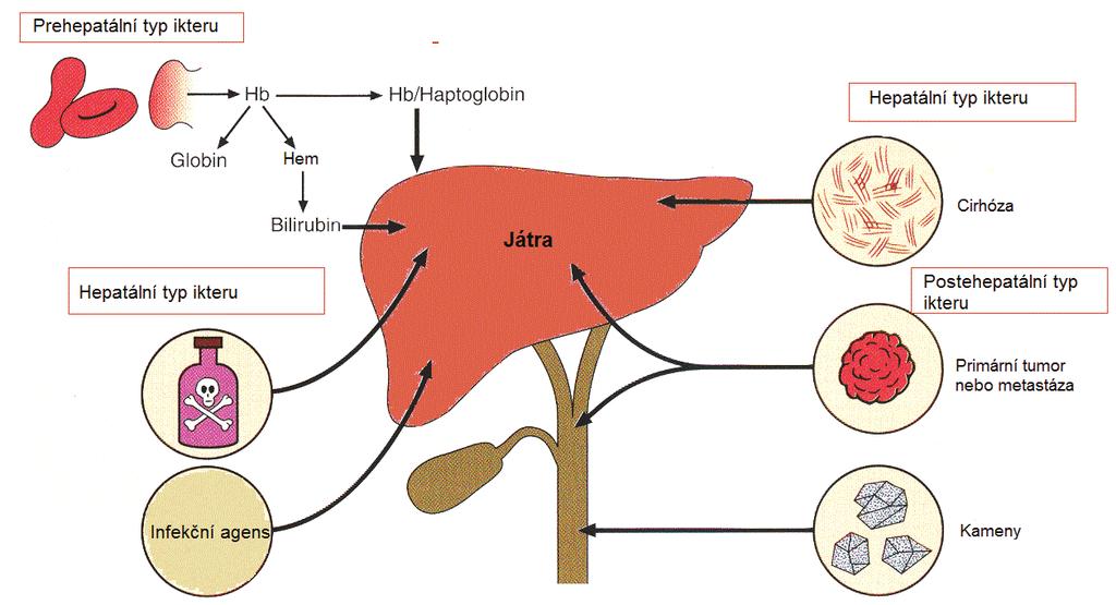 Obrázek č. 4. Příčiny vzniku ikteru. Upraveno dle Clinical Biochemistry, An Illustrated Colour Text, 5 th edition, Gaw A a kol., 2008.