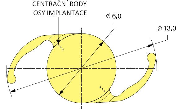 o více než kritických 10 u 46 % případů implantace. Snahy kompenzace těchto vysokých hodnot vedly cestou zvětšování celkového průměru čočky pro lepší kontakt s kapsulárním vakem.