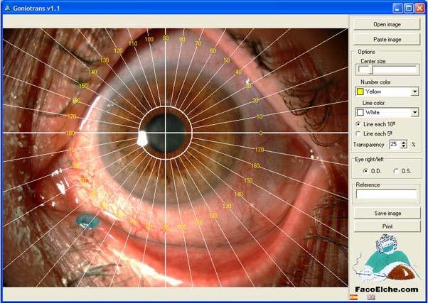 2.3.1 Aplikace Goniotrans Goniotrans je volně šiřitelný software pro jednoduchou definici úhlové polohy struktur předního segmentu oka.