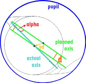 reziduální astigmatismus [D] 1,00 0,90 0,80 0,70 0,60 0,50 0,50 0,40 0,30 0,20 0,25 0,10 0,00 0,40 0,60 0,80 1,00 1,20 1,40 subjektivní pooperační zraková ostrost [visus] Graf 3.