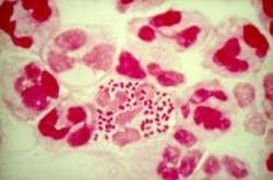 KAPAVKA Přenos choroby: gonokok Neisseria gonorrhoeae, přenos pohlavním stykem, vzácně nepřímou cestou