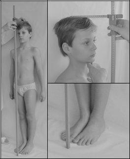 5. Antropometrické metody Jedná se o jednoduché neinvazivní metody, které nám pomáhají zhodnotit stav metabolismu a výţivy (17).
