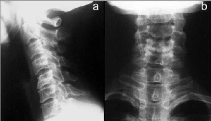 Obrázky Obrázek 1: Degenerativní změny středního úseku krční páteře.