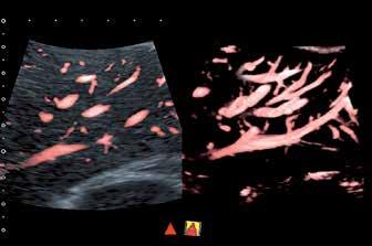 Vidět neviditelné Funkce Superb Micro-Vascular Imaging (SMI) rozšiřuje rozsah