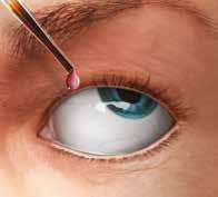 Aplikujte dezinfekční prostředek (například 10% roztok jodovaného povidonu) na kůži kolem oka, očních víček a očních řas a vyhněte