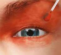 Informujte pacienta, aby se díval směrem od místa aplikace injekce. Zajistěte správné postavení oka.