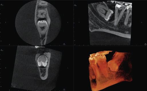 8 cm pro celou čelist: Plánování vícenásobných implantátů v