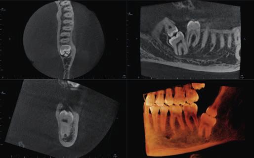 vícenásobných implantátů v obou čelistech Chirurgické