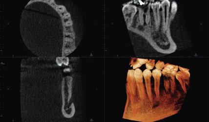 optimalizované 3D rentgenové snímky při použití nízké dávky záření.