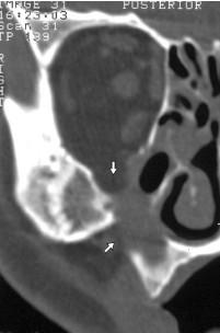 Atelaktáza čelistní dutiny po operaci dle Caldwell Luca u 19leté nemocné s defektem stropu a laterální stěny čelistní dutiny a prolapsem tkání očnice do antra.