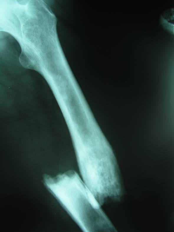 OSTEO s