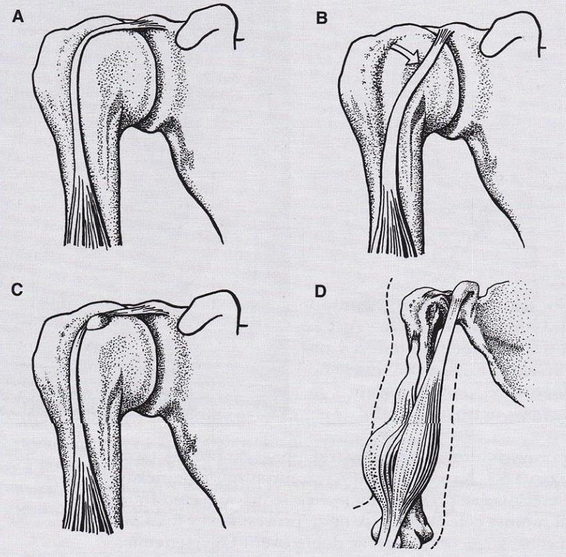 Obrázek 1 Patologie šlachy dlouhé hlavy m.biceps brachii A- normální nález B- subluxace šlachy C- zánět šlachy D- ruptura šlachy Zdroj: Trnavský, Sedláčková, 2002 2.