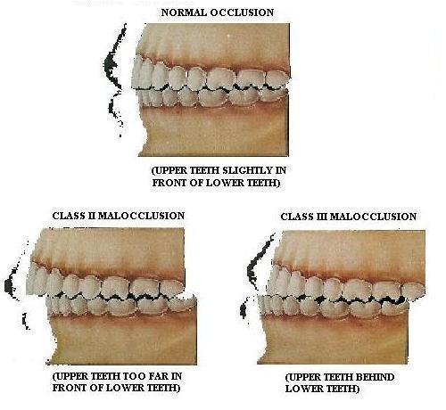 Skus, okluze: (oclusio) styk horních a dolních zubů při sevřených čelistech se nazývá skus okluze (oclusio)