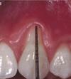 gingivální recese - úbytek dásně snížení