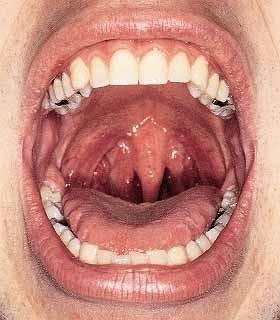 stopkyvazivovým pouzdrem (capsula tonsillaris) povrch je nerovný s četnými