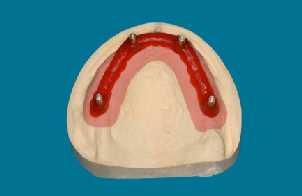 Stavění zubů a zhotovení otvorů v oblasti implantátů 13.