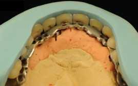 Podbarvení konstrukce Obrázek 40 - Umístění zubů za pomocí silikonových klíčů (9) Obrázek 41 -