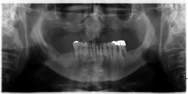 5. Praktická část Ve své praktické části se zabývám zkvalitněním života pacienta po přechodu z konvenční snímatelné náhrady na náhrady kotvené implantáty.