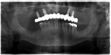 Obrázek 45 - stav DÚ po zavedení implantátů (vlastní zdroj) Obrázek 46 - pacient