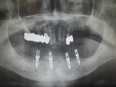 Obrázek 49 - stav DÚ po zavedení implantátů (vlastní zdroj) 5.2.2 Rozhovor s pacientem 1. Co vás vedlo ke změně náhrady? a.