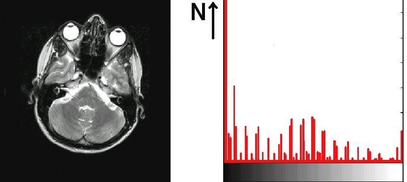 A) B) Obr. 1. Histogram obrazu. MR snímek (A) a jeho histogram (B). N vyjadřuje počet výskytů jasu určité úrovně v obraze. Parametry 2. řádu jsou odvozené z matic šedotónových závislostí [12].