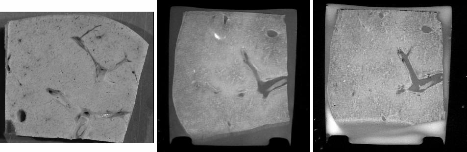 Výsledky separace zdravých a cirhotických jater in vitro shrnuje tabulka 4. Nejlepších výsledků bylo dosaženo použitím gradientní sekvence, kde správnost separace byla vždy 100% úspěšná.