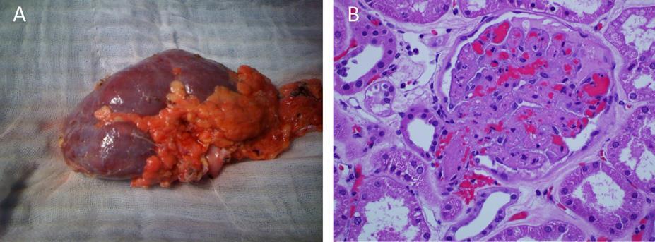 CDC+ kidney transplantation R.A.