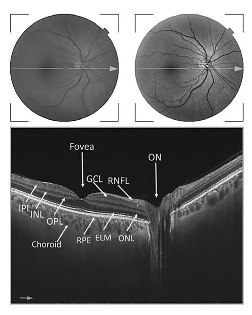 Neurologická zobrazovací vyšetření u očních onemocnění Chwalisz a spol.
