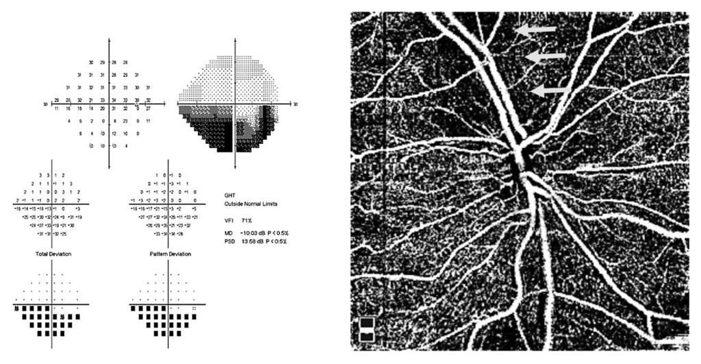 Neurologická zobrazovací vyšetření u očních onemocnění Chwalisz a spol. postižením přední části zrakové dráhy.